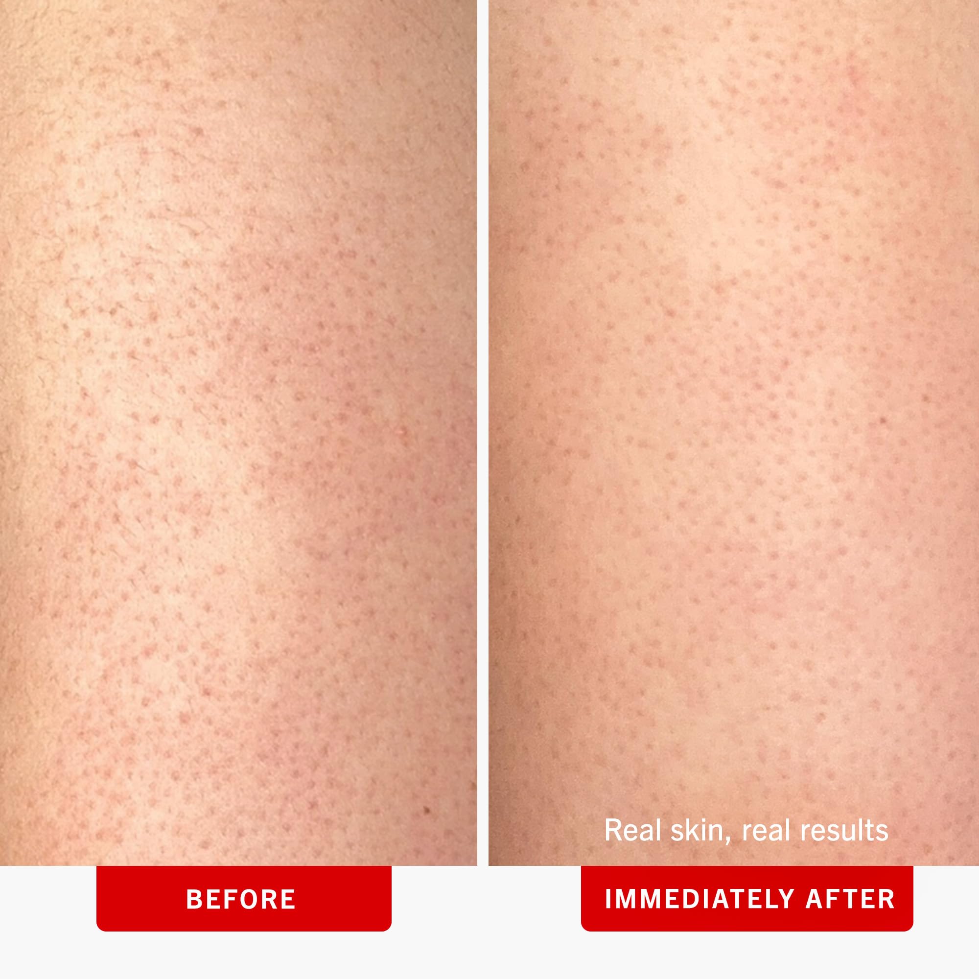 First Aid Beauty - KP Bump Eraser Body Scrub with 10% AHA, Keratosis Pilaris Exfoliator with Glycolic and Lactic acids, Helps Reduce Chicken Skin Bumps, Safe for Sensitive Skin, Strawberry Scent, 8 oz